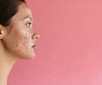 Antioxidant-rich diets linked to better life quality in young women with acne