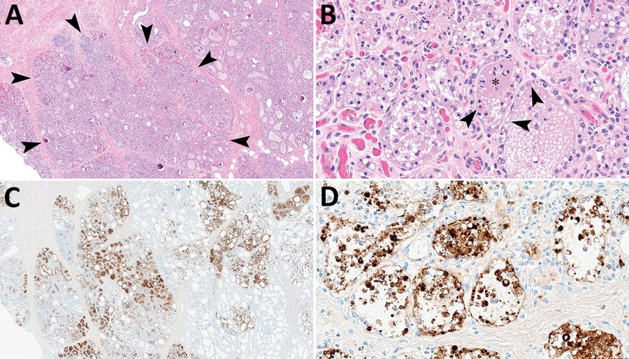 Mammary gland lesions in cattle in study of highly pathogenic avian influenza A(H5N1) clade 2.3.4.4b virus infection in domestic dairy cattle and cats, United States, 2024. A, B) Mammary gland tissue sections stained with hematoxylin and eosin. A) Arrowheads indicate segmental loss within open secretory mammary alveoli. Original magnification ×40. B) Arrowheads indicate epithelial degeneration and necrosis lining alveoli with intraluminal sloughing. Asterisk indicates intraluminal neutrophilic inflammation. Original magnification ×400. C, D) Mammary gland tissue sections stained by using avian influenza A immunohistochemistry. C) Brown staining indicates lobular distribution of avian influenza A virus. Original magnification ×40. D) Brown staining indicates strong nuclear and intracytoplasmic immunoreactivity of intact and sloughed epithelial cells within mammary alveoli. Original magnification ×400.