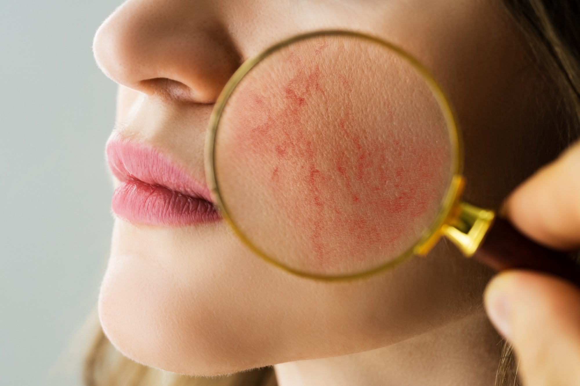 Study: Rosacea is strongly associated with melanoma in Caucasians. Image Credit: Andrey_Popov/Shutterstock.com