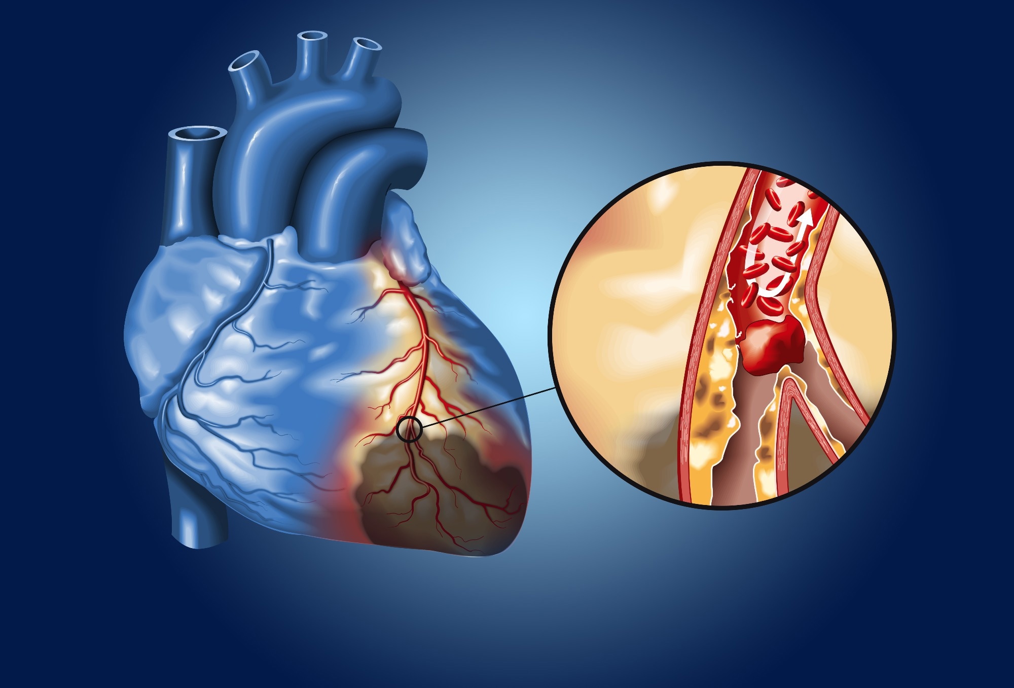 Study: Inflammatory risk and cardiovascular events in patients without obstructive coronary artery disease: the ORFAN multicentre, longitudinal cohort study. Image Credit: Axel_Kock / Shutterstock.com
