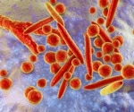Unusual surge in children's pneumonia cases in England linked to Mycoplasma pneumoniae