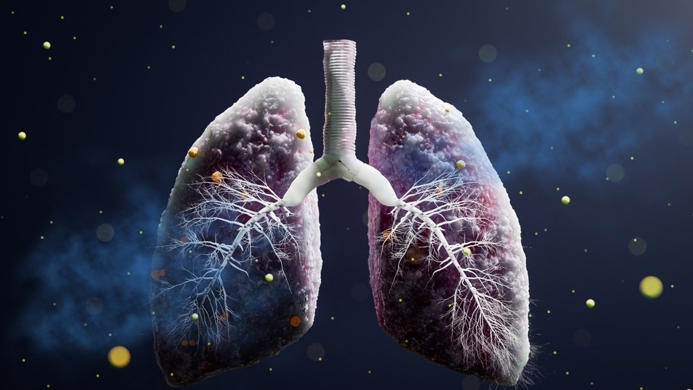 Study: Incidence and risk factors for coronavirus disease 2019-associated pulmonary aspergillosis using administrative claims data. Image Credit: CI Photos/Shutterstock.com