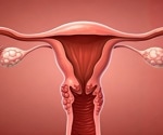 History of endometriosis and fibroids linked to higher long-term risk of early death