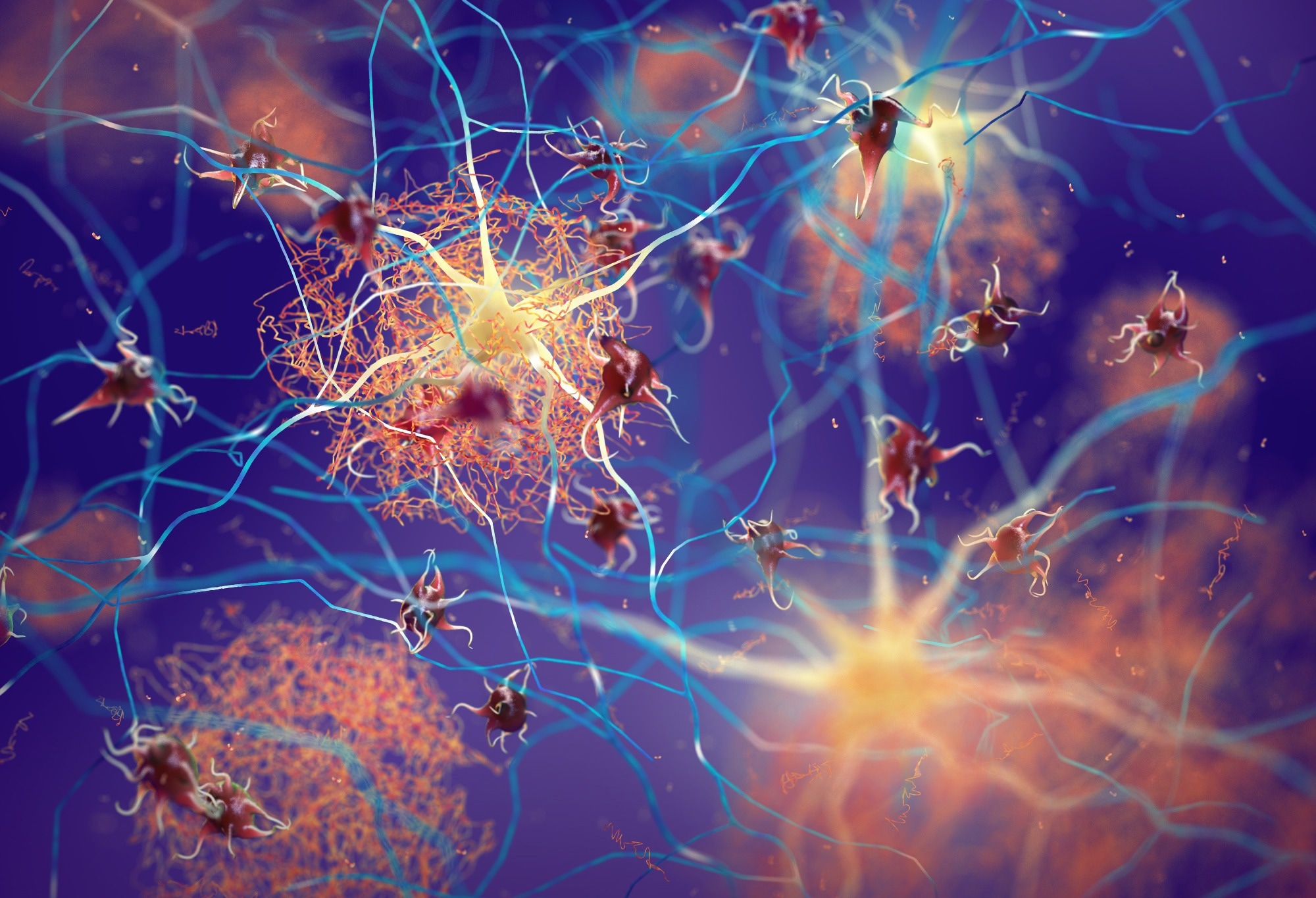 Amyloid plaques forming between neurons 3d ilustration.