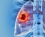 Multi-omic profiling sheds light on chemo-immunotherapy resistance in lung cancer