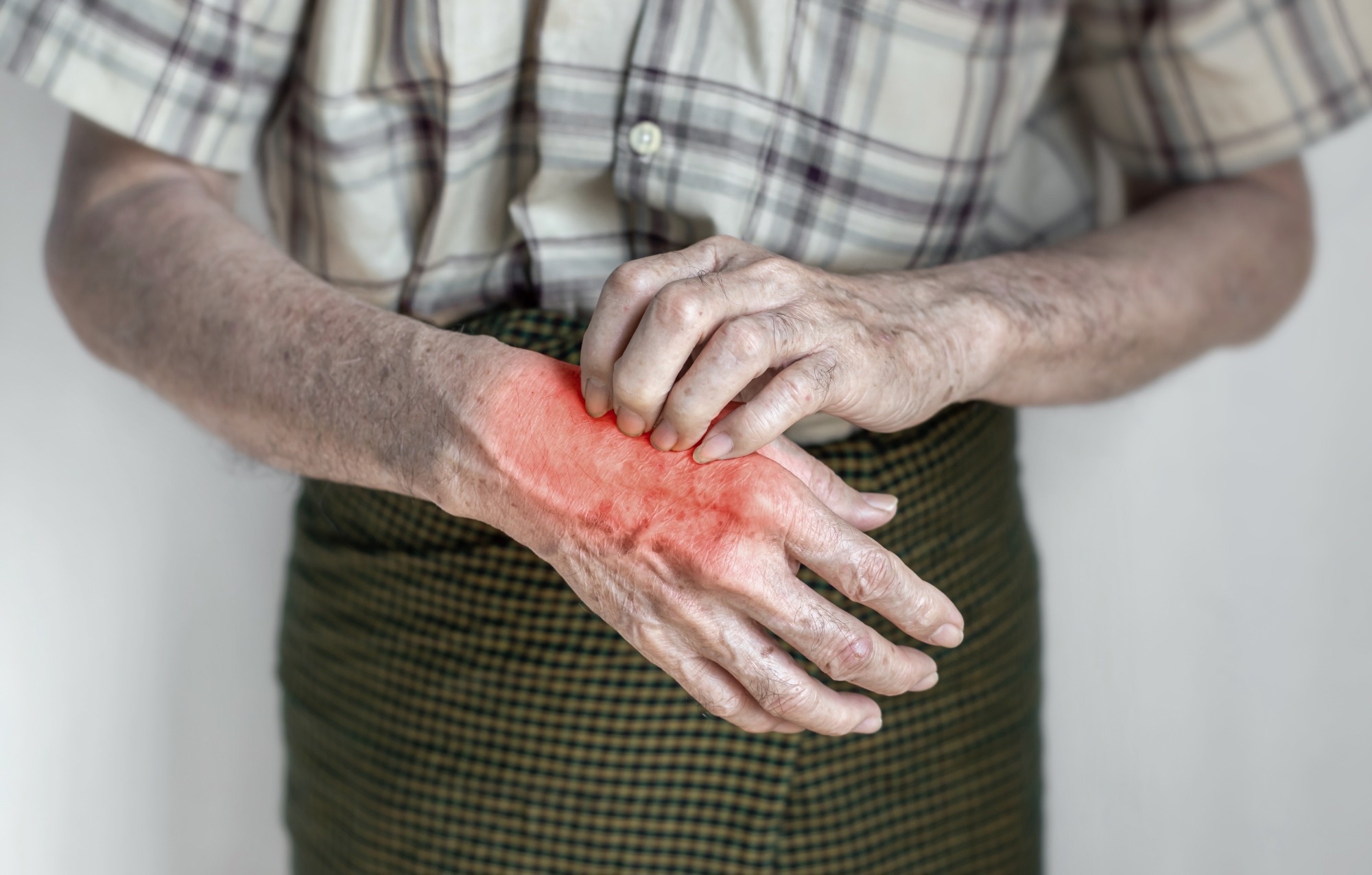 Study: Heated Mittens for Patients with Hand Osteoarthritis: A Randomized Trial. Image Credit: Zay Win Hatal / Shutterstock.com