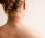 How stress fuels allergic skin inflammation