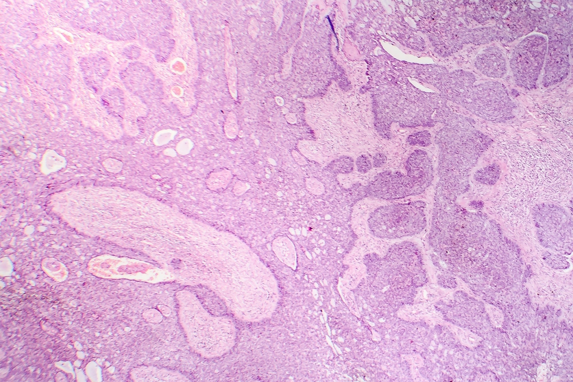 Basal cell carcinoma.