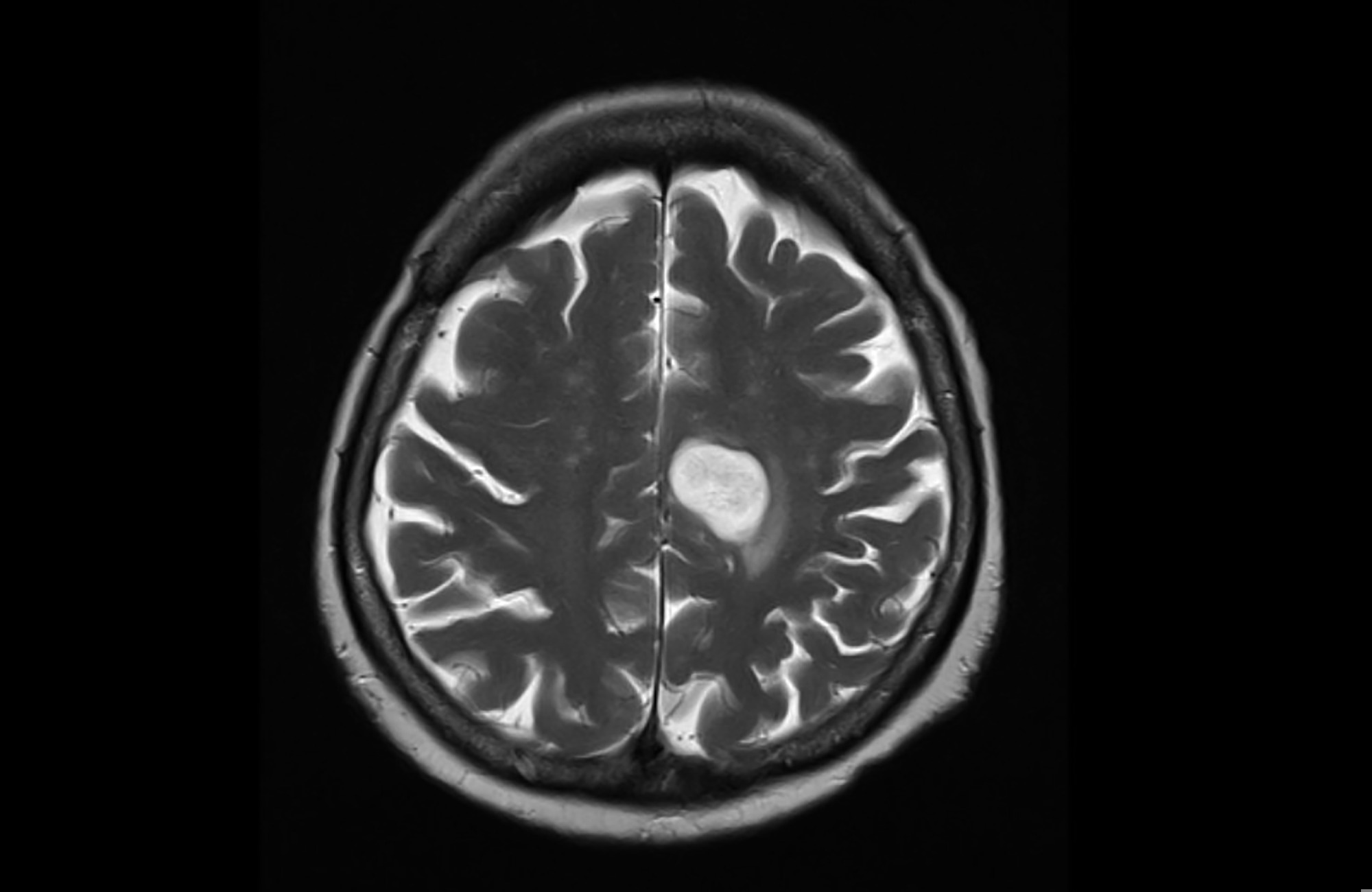 Study: Glioma mutational signatures associated with haloalkane exposure are enriched in firefighters. Image Credit: Yok_onepiece / Shutterstock.com
