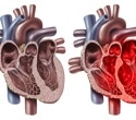 US hospitals see rising complications in patients with takotsubo cardiomyopathy