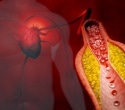 Coronary inflammation marker helps identify hidden heart risk in young adults