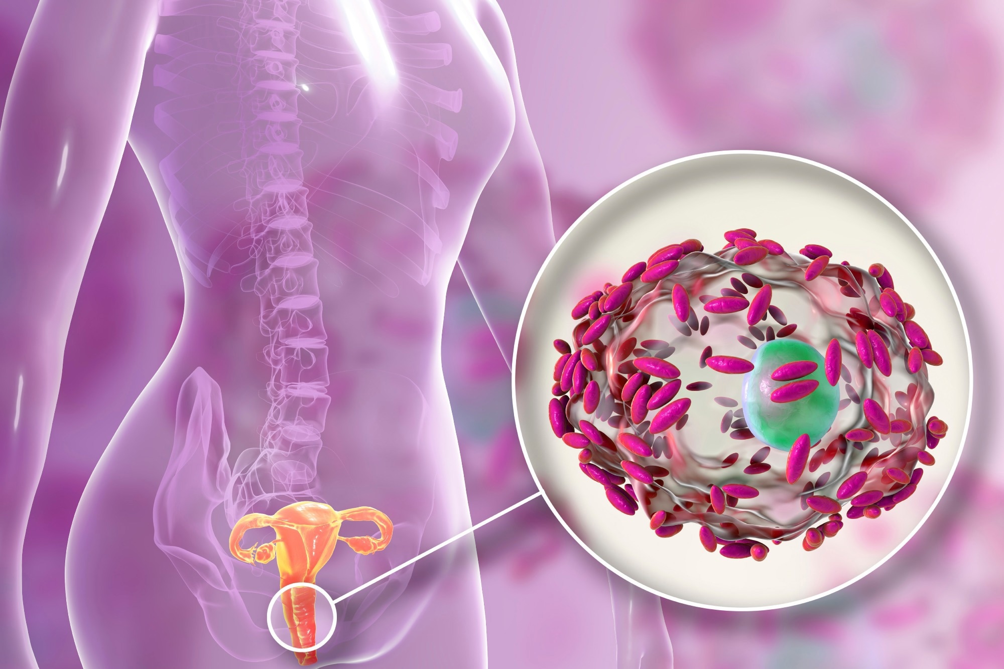 3D graphic of bacterial vaginosis