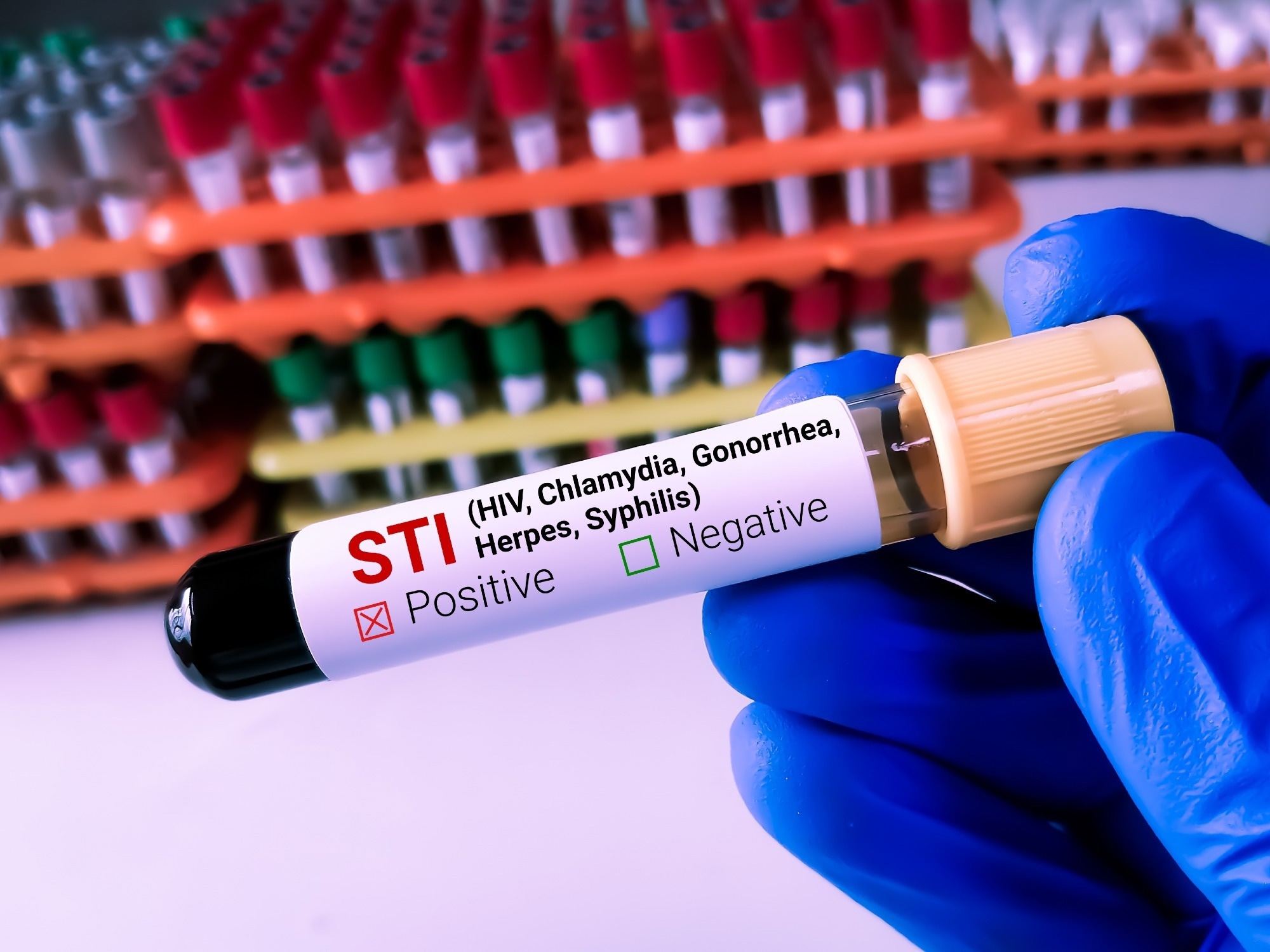 Lab Technologist holds Blood sample for STI