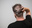 Sugary drinks increase hair loss risk, scientists warn