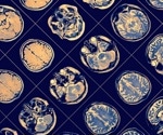 Blood and brain biomarkers transform how doctors confirm Alzheimer’s disease