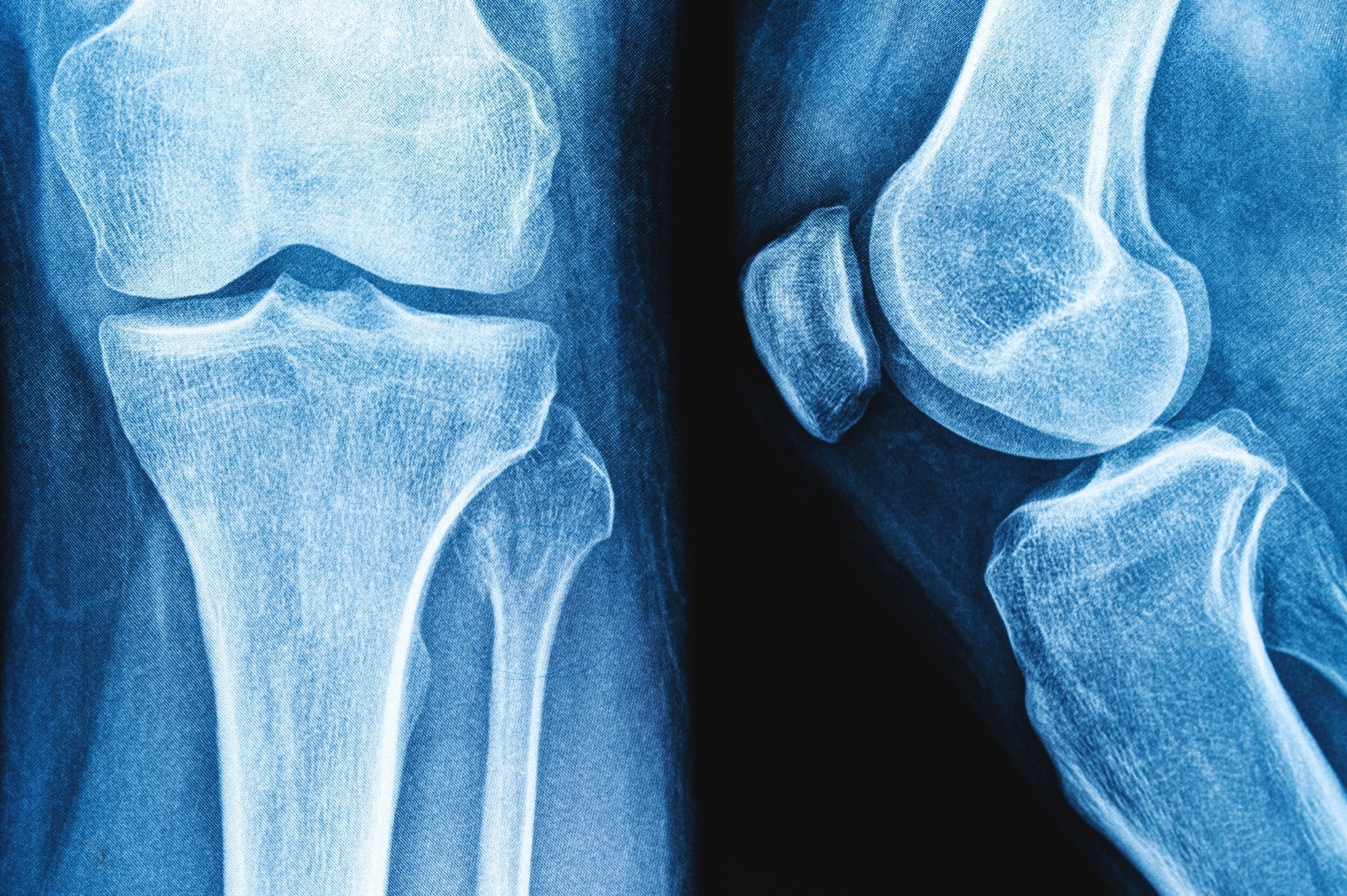 Review: Impact of yogurt consumption on bone health markers in adults with or without osteoporosis: a systematic review and meta-analysis. Image Credit: siamionau pavel / Shutterstock