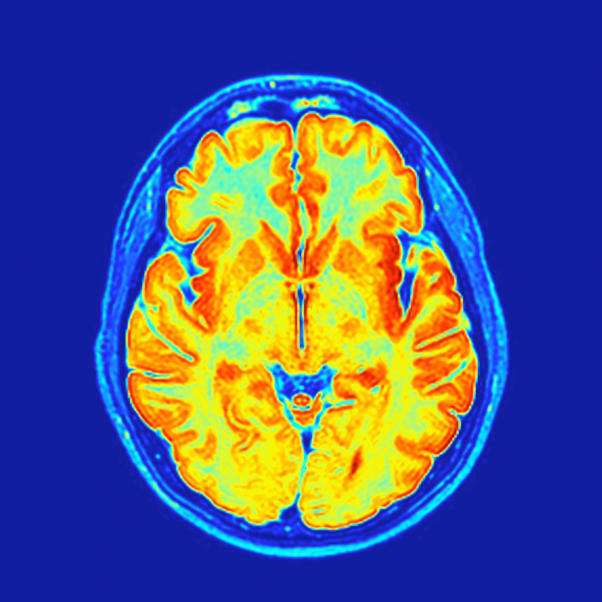 Axial MRI section of a human brain post-processed with colors showing the gray matter, white matter, ventricles and calvaria
