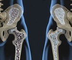 Routine blood test may flag hidden osteoporosis risk, study finds