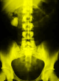 Obesity and weight gain are associated with increased risk for developing kidney stones, according to a study in the January 26 issue of JAMA.