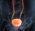 Urine cfDNA patterns emerge as a promising tool for diagnosing bladder cancer