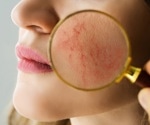People with eczema can bathe daily or weekly without worrying about flare-ups