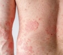 Innovative vibroacoustic sensor could revolutionize eczema and psoriasis treatment