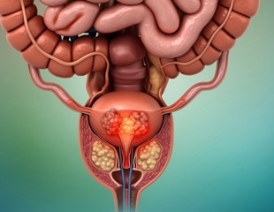 Study tests combined targeted radiopharmaceuticals and precision radiation for recurrent prostate cancer