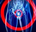 Breakthrough treatment for advanced prostate cancer could eliminate severe side effects