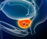 Faster and cheaper MRI proves effective in detecting prostate cancer