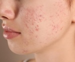 Study examines how often acne recurs after isotretinoin treatment