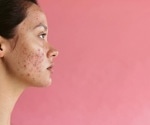 Researchers work to defeat acne by understanding it better on a molecular level