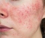 Accure Acne secures FDA clearance for long-term acne solution