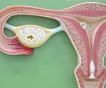 Researchers call for better recognition and pain management of endometriosis