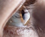 AI-based glaucoma screening could revolutionize eye health